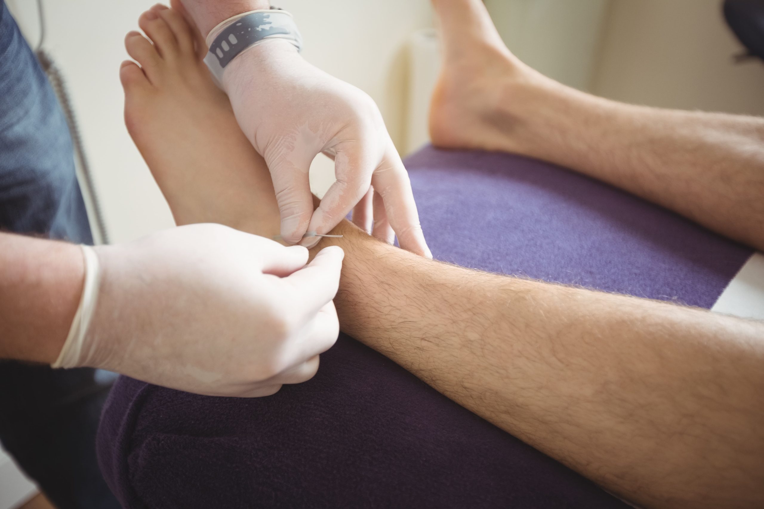 How to Remove Verrucas with Professional Treatment