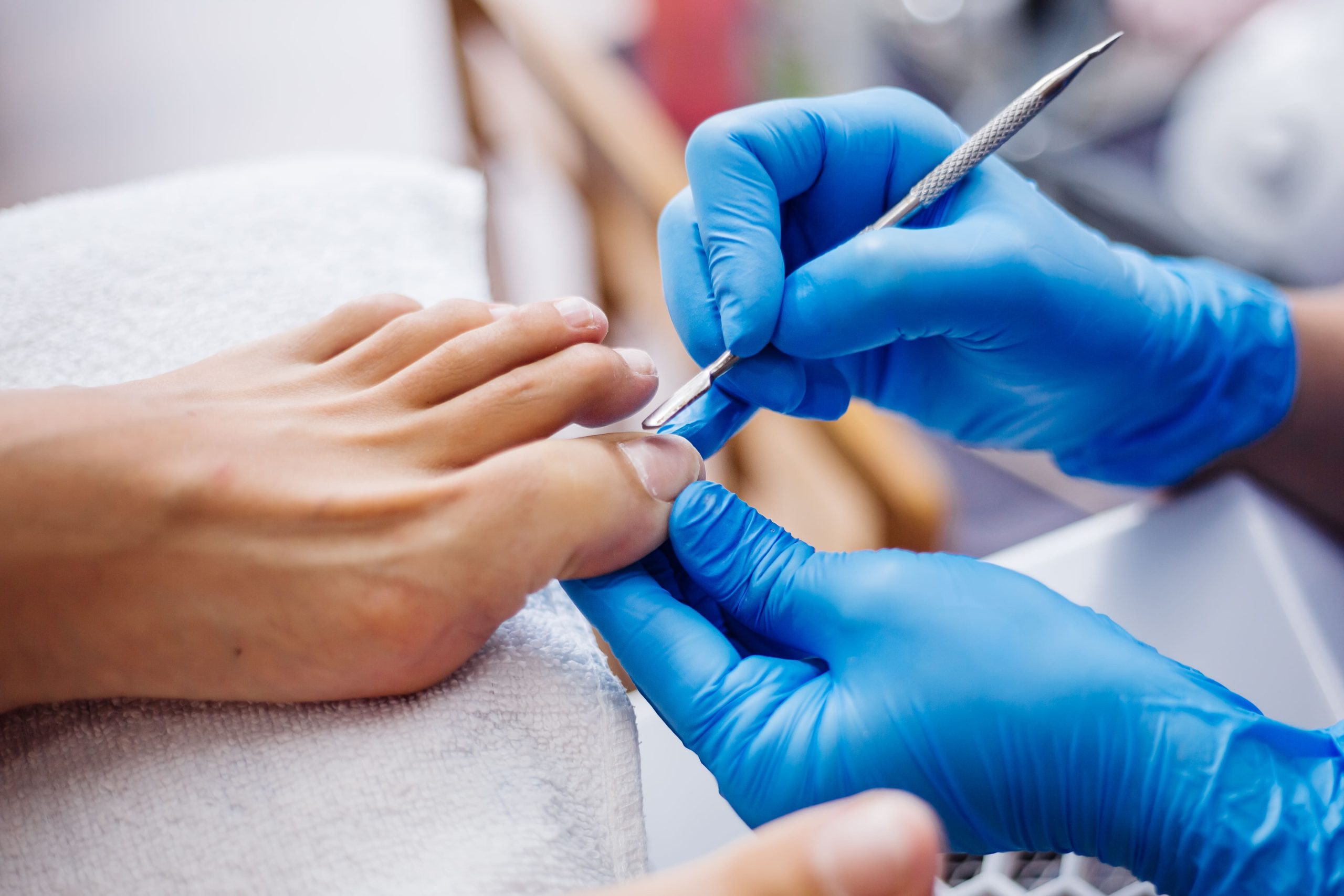 How Podiatrists Can Help In Treating Ingrown Toenails?